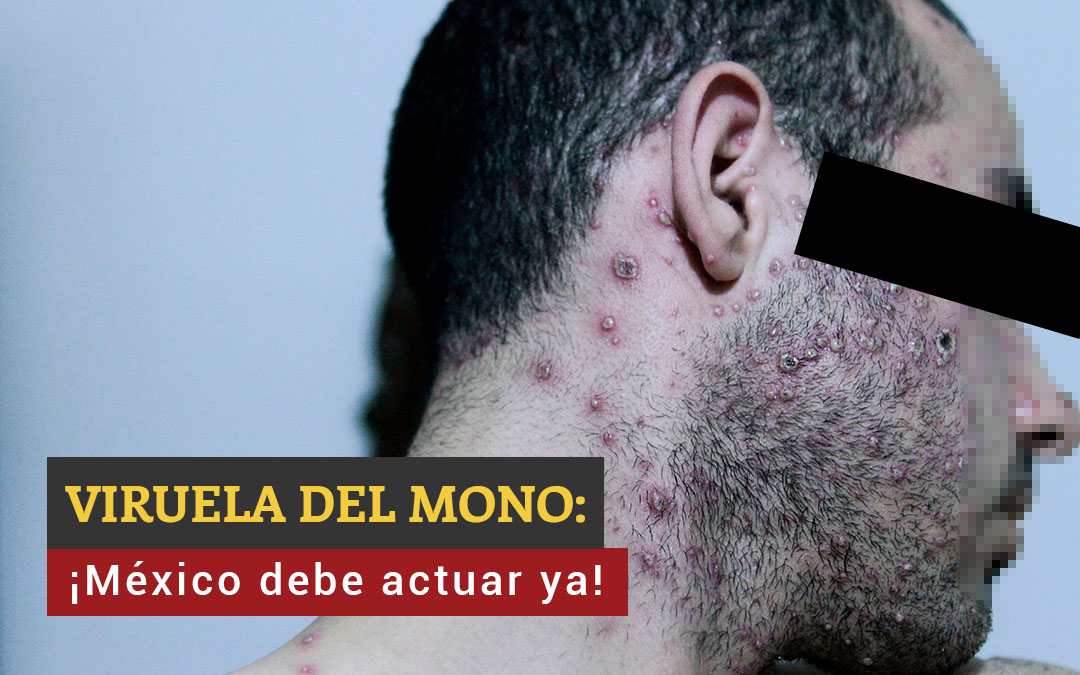 monkeypox (1)